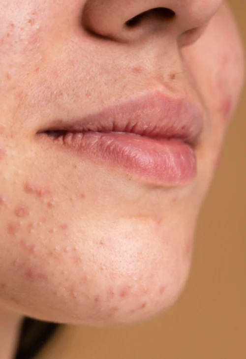 Laser & Rejuvenation